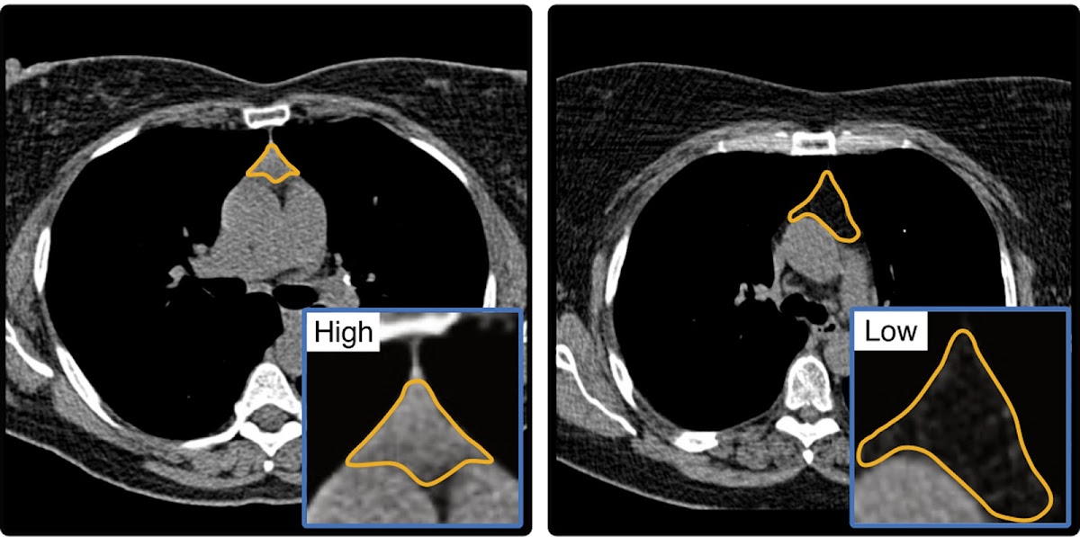 딥러닝으로 CT에서 흉선 건강 분석 — '건강한 흉선이면 사망률 50% 낮다'