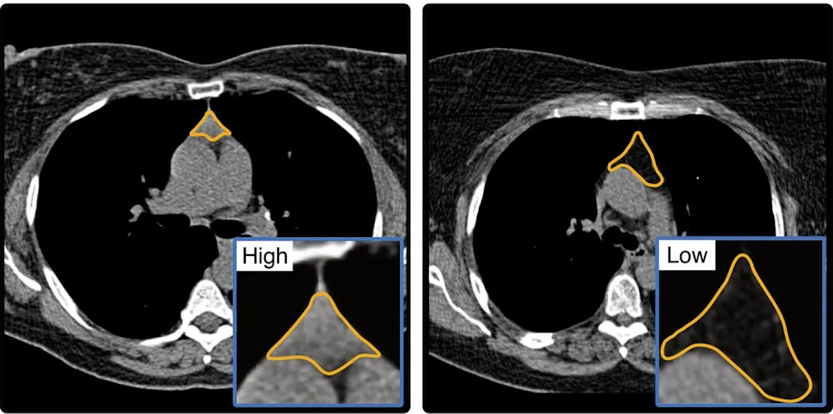 딥러닝으로 CT에서 흉선 건강 분석 — '건강한 흉선이면 사망률 50% 낮다'